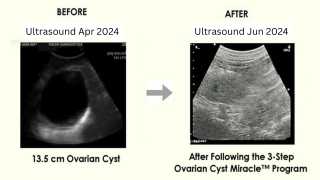 Ovarian Cyst Miracle Program.webp