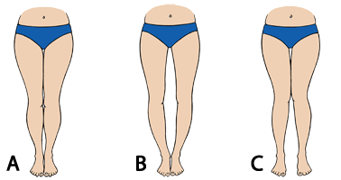 bow-legs-diagram