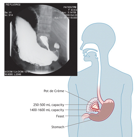 Illustration showing, jokingly, a dessert stomach as an extension of the regular one. Source: https://www.cmaj.ca/content/175/12/1567.short